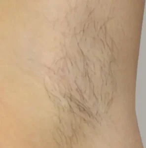 Електроепілятор Sinepil (Selenia) 8 до процедури електроепіляції в зоні пахви